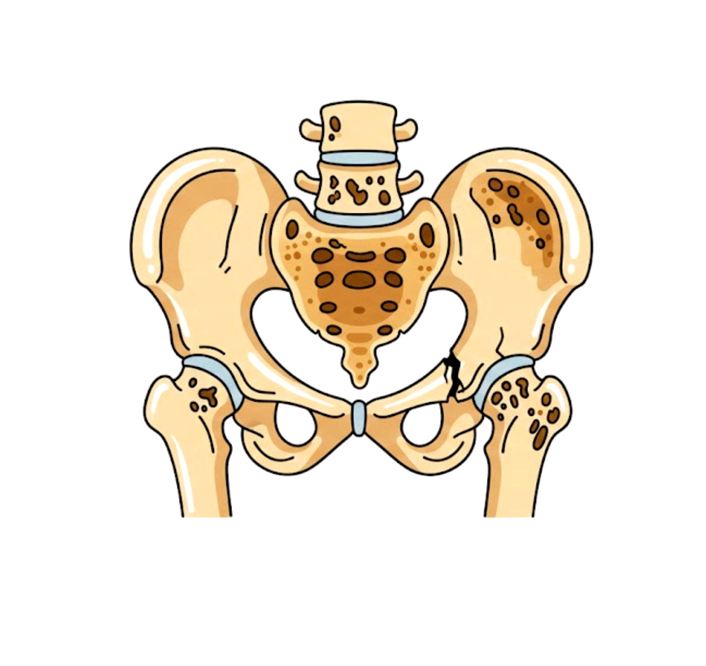 Proč jsou zlomeniny u osteoporózy častější